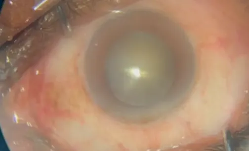 Superior Oblique Intorsion