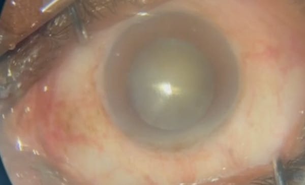Superior Oblique Intorsion thumbnail