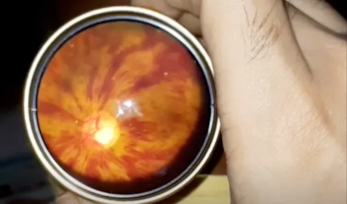 Central Retinal Vein Occlusion