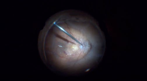 IVT-Related Retinal Detachment