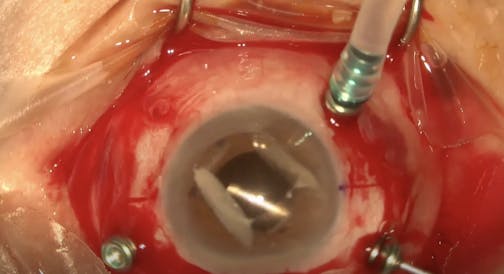 Subluxated IOL Rescue in Fuchs Dystrophy