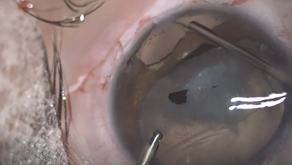 Traumatic Cataract With Zonular Dialysis and Vitreous Prolapse thumbnail