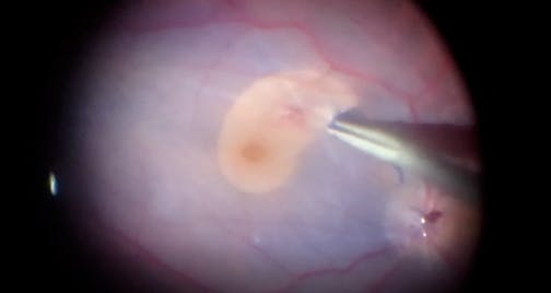 Managing PVR Retinal Detachment With ILM Peel Under Perfluorocarbon Liquid
