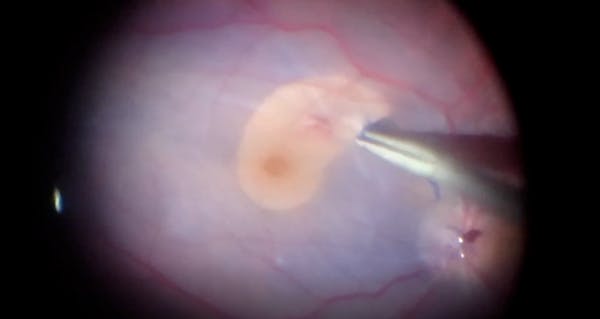 Managing PVR Retinal Detachment With ILM Peel Under Perfluorocarbon Liquid thumbnail