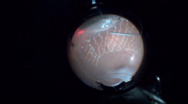 Vitrectomy for Diabetic Neovascular Glaucoma thumbnail