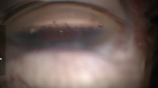 Blanching of the Canal