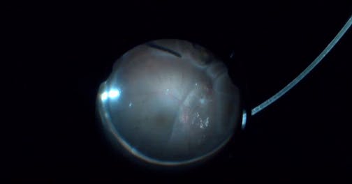 Recurrent Retinal Detachment