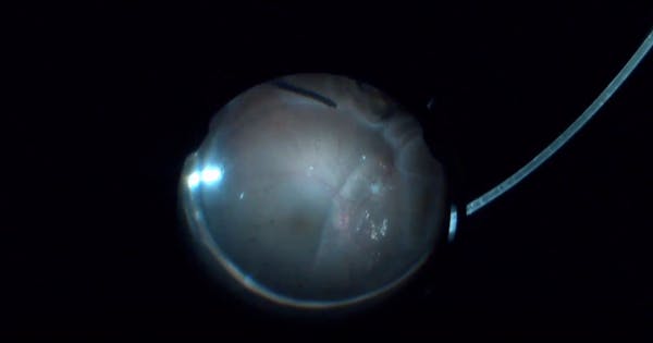 Recurrent Retinal Detachment thumbnail