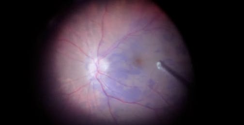 Pearls for Performing a Double Peel