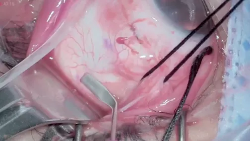 Heads-Up Sutureless Chandelier-Assisted Scleral Buckle
