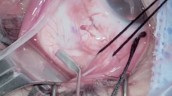 Heads-Up Sutureless Chandelier-Assisted Scleral Buckle thumbnail