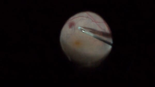 Restoration of Foveal Contour After ERM Surgery thumbnail