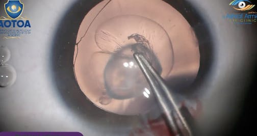 Posterior Lenticonus