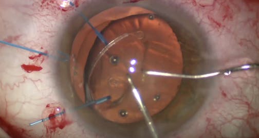 Subluxed Cataract