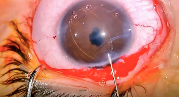 Bilateral Anterior Lens Dislocation thumbnail