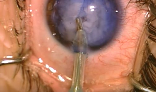 Traumatic Cataract With Iris Loss