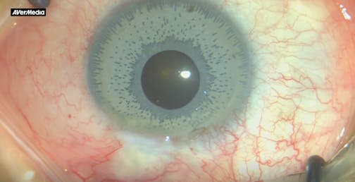 Colored Iris Implant Disaster