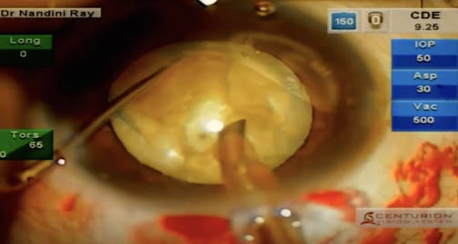 Mature Cataract With Anterior Capsule Tear