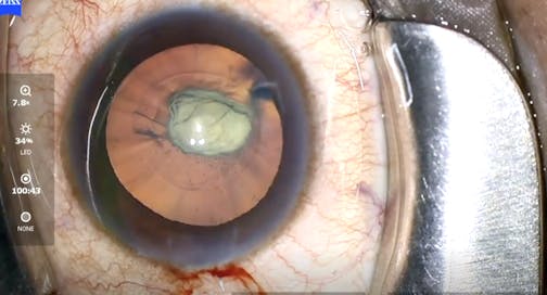 Fluid Misdirection With Posterior Polar Cataract