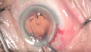 Implantation Surprise
