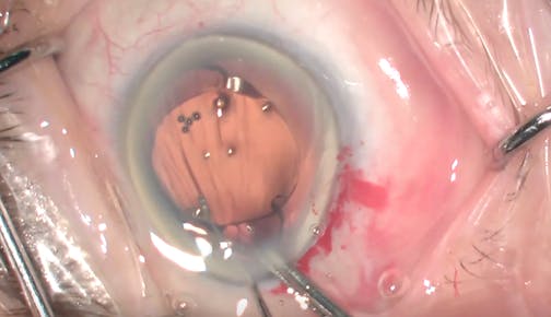 Implantation Surprise