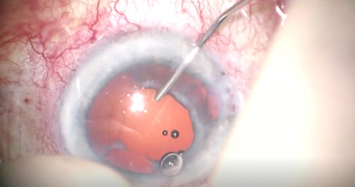Secondary Implantation Following Choroidal Hemorrhage