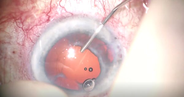 Secondary Implantation Following Choroidal Hemorrhage thumbnail
