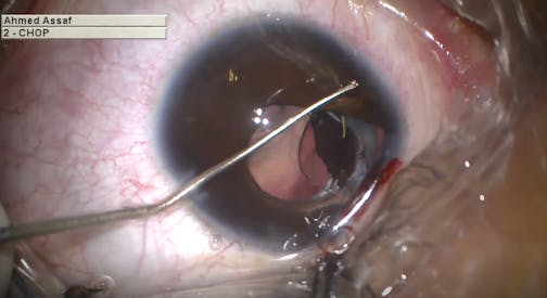 Chronic Anisometropia