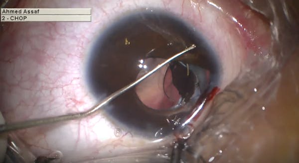 Chronic Anisometropia thumbnail