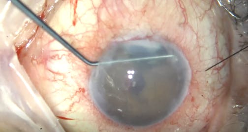 Fuchs Dystrophy With Extreme Hyperopia