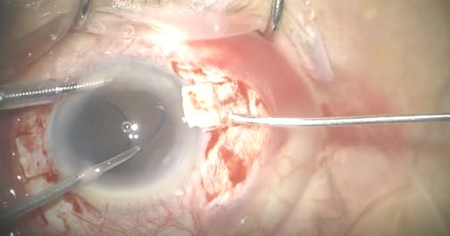 CME, Dislocated IOL, and Aphakia: Three Techniques