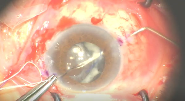 Subluxed IOL/Bag Complex With Pseudoexfoliation thumbnail