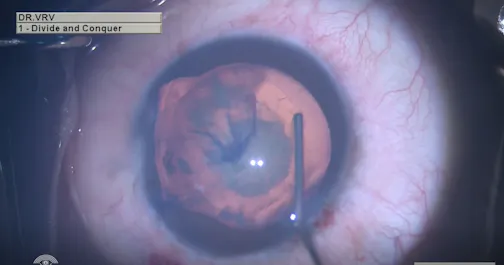 Phacoemulsification in an Eye With a Traumatic Cataract and Zonular Dialysis