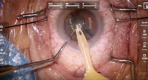 Early Experience With Zeiss Quatera 700