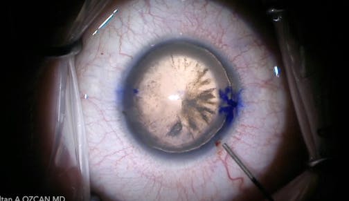Management of Congenital Aniridia With Cataract