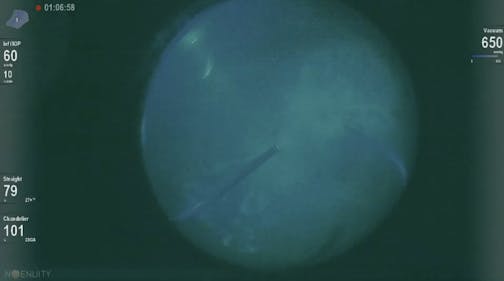 Intraoperative Fluorescein Angiography