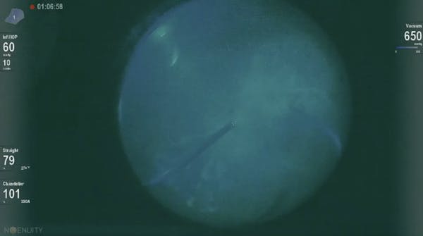 Intraoperative Fluorescein Angioscopy thumbnail