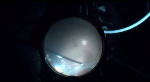 Combined Surgery for Phakic Retinal Detachment