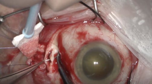 A Hidden and Unexpected Perforating Globe Laceration