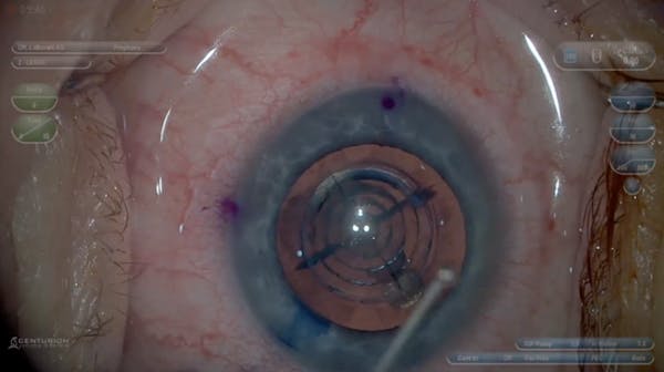 Ngenuity 3D Visualization Impact on Cataract Surgery thumbnail