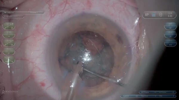 Femtosecond Advantage in Zonular Weakness thumbnail