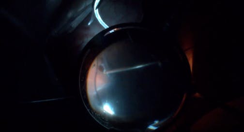 PVR Retinal Detachment