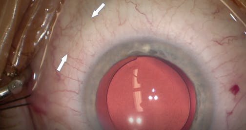 Viscoelastic Delivery and Blanching With Streamline