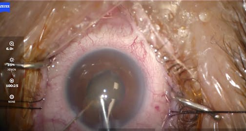 Small Pupil and Pseudoexfoliation