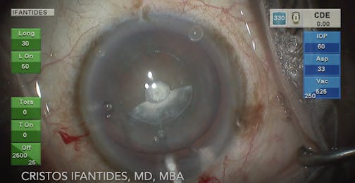 Anterior Polar Zepto