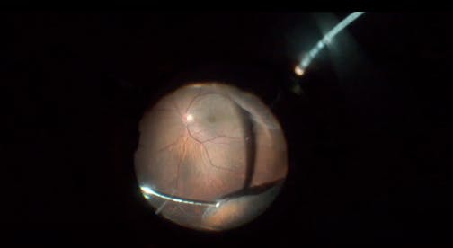 Posterior Drainage Retinotomy