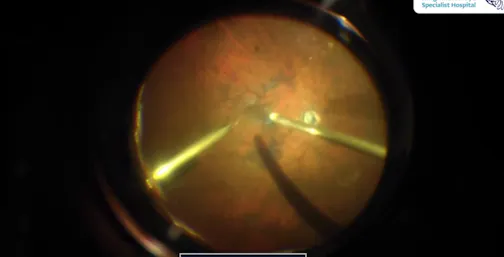 Cataract With Persistent Full Thickness Macular Hole