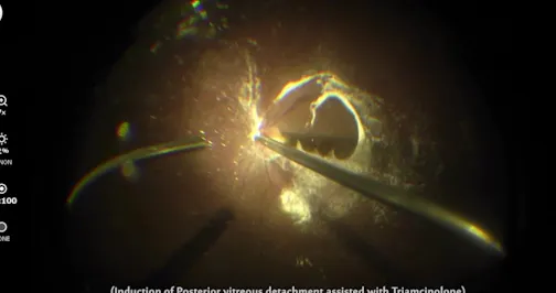 Amniotic Membrane Patch Combined With ILM Inverted Flap
