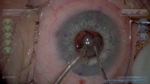 A Small Pupil Challenge