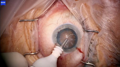 Nucleus Fragmentation With miLoop in Hypermature Cataract